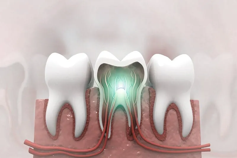 emergency rootcanal 3
