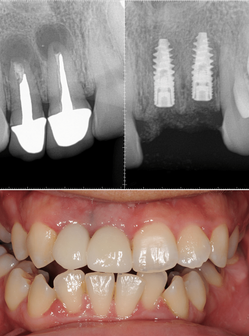 Dental Implants front teeth copy-lr
