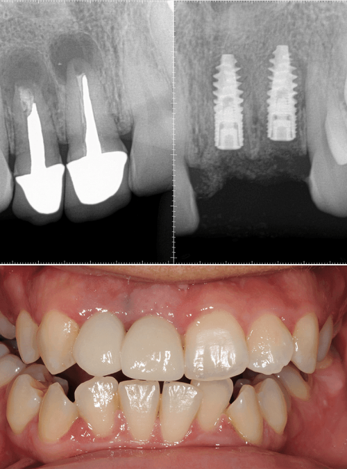 Dental Crowns California Burbank