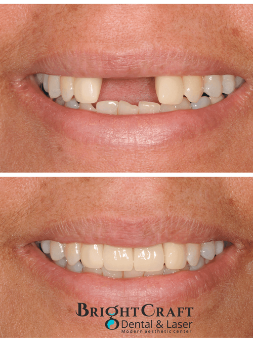 Dental Implants before and after