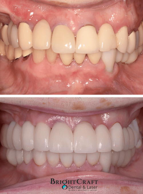 Full mouth reconstruction with implants AND cosmetic crowns 1 copy-lr