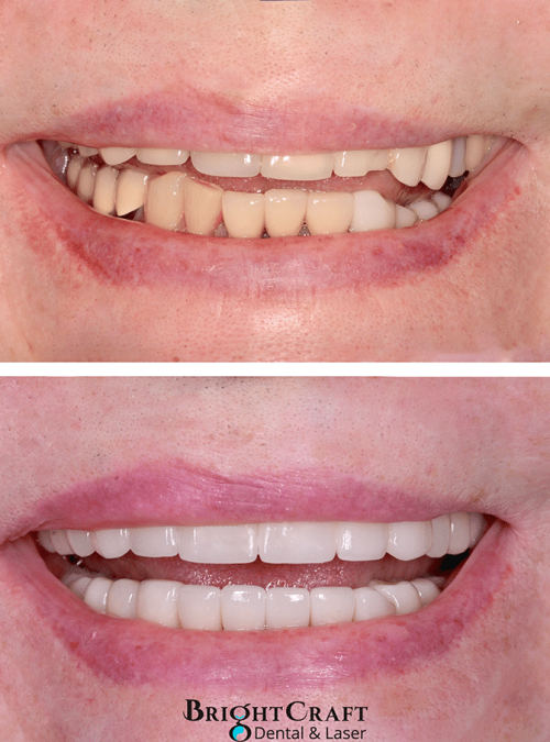 Full mouth reconstruction with implants AND cosmetic crowns copy-lr