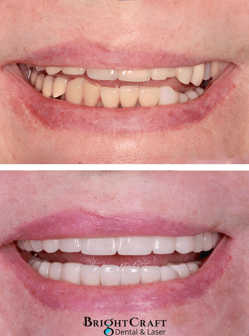 Full mouth reconstruction with implants AND cosmetic crowns copy-lr