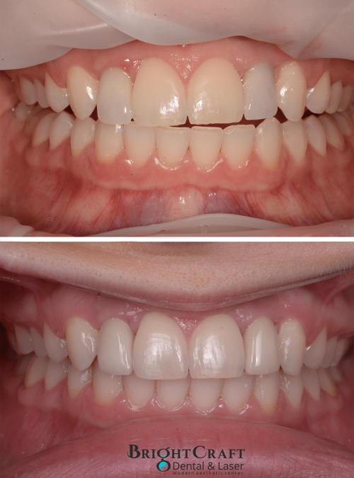 Replacement of old discolored implant crowns and Zoom! whitening copy-lr