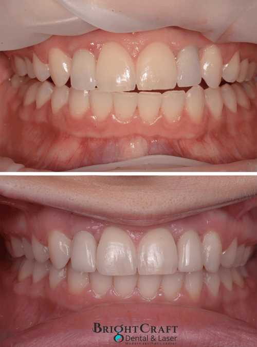 Replacement of old discolored implant crowns and Zoom! whitening copy-lr