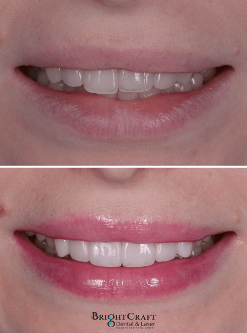 Replacement of old discolored porcelain veneers copy-lr