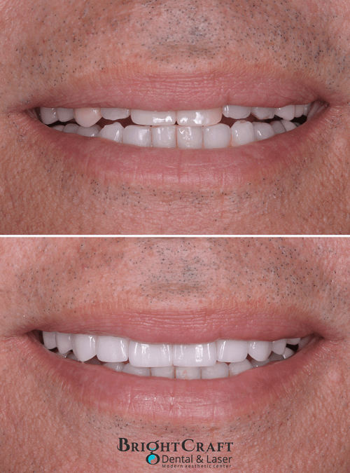 Veneers before and after