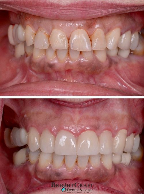 Veneers price