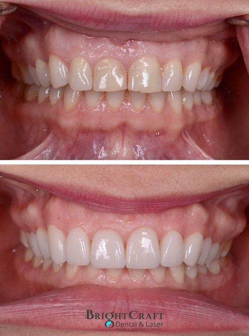 Veneers cost+price