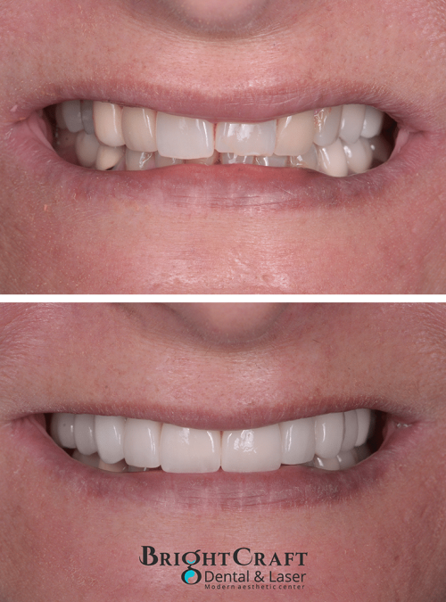 Veneers before and after 2