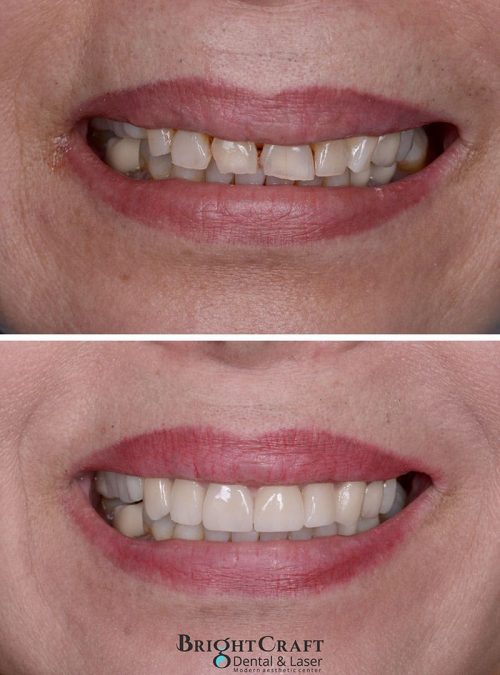 Veneers before and after 3