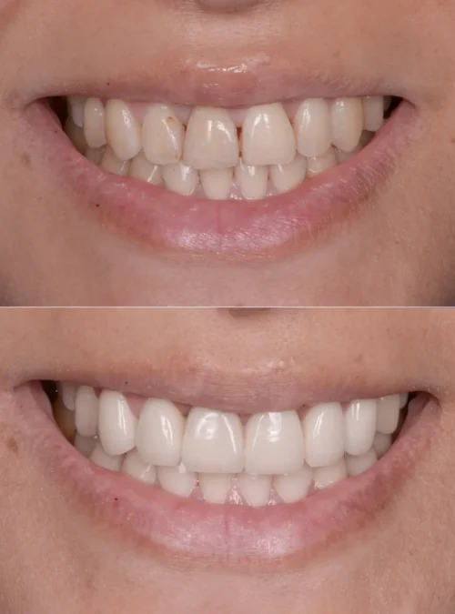 veneers-01