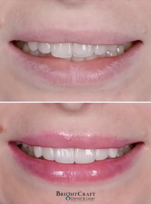 veneers-06